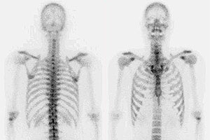 A bone scan was music to my ears